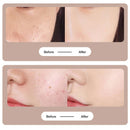 Pen Mole & Dark Spot Remover – Professional Skin Treatment at Home