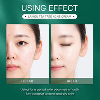 Anti-Acne Face Cream – Clearer Skin, Lasting Hydration